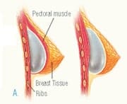 inserting-implant - Breast Augmentation – Factors