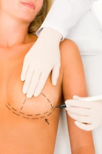 Breast implant placement